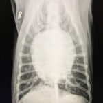 Dilated Cardiomyopathy and Atrial Fibrillation