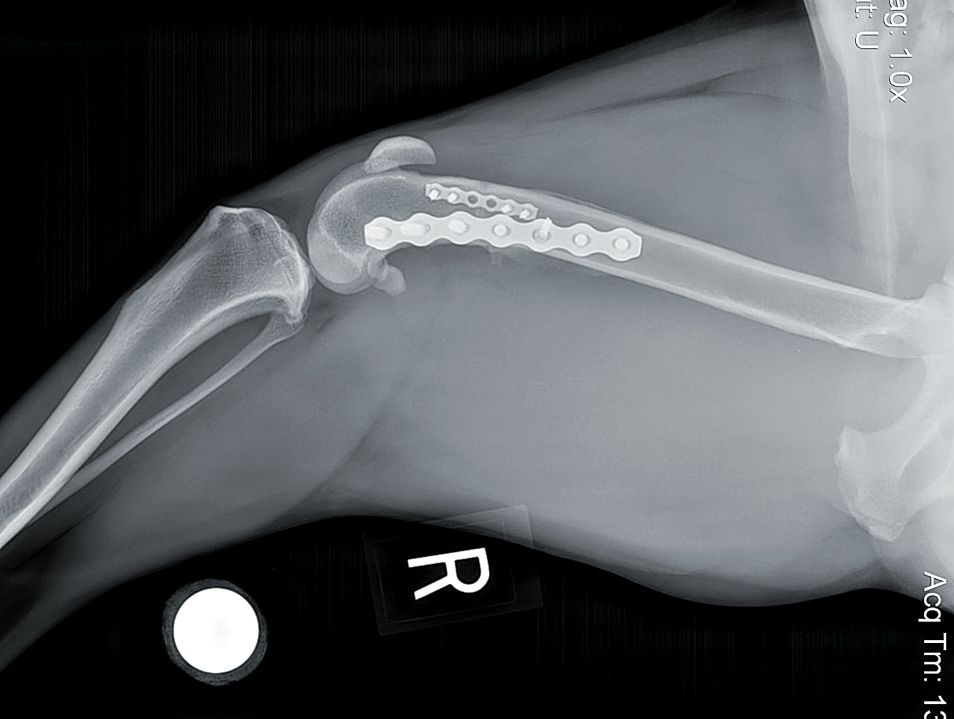 x-ray of Distal Femoral Osteotomy