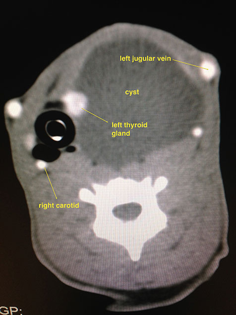 Branchial Cyst-476