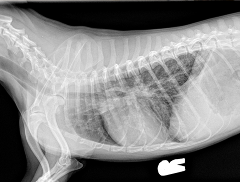 Eosinophilic Bronchopneumopathy Thorax Xray